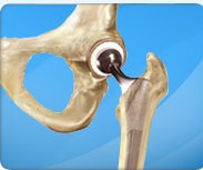 Minimally invasive total hip replacement