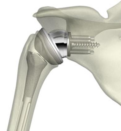 Reverse Shoulder Arthroplasty 